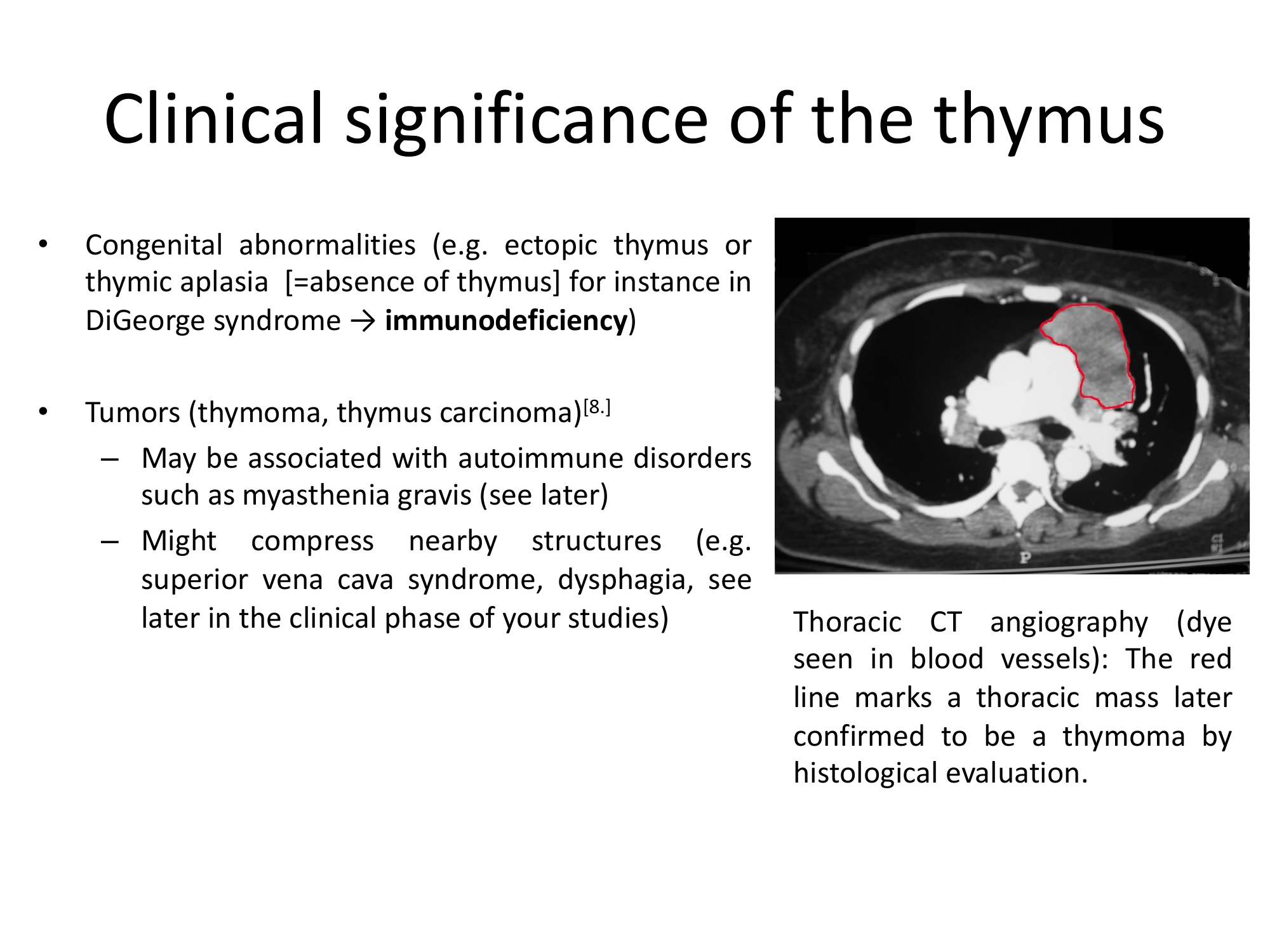 Before: Original slide 19 — CT and thymoma clinical images