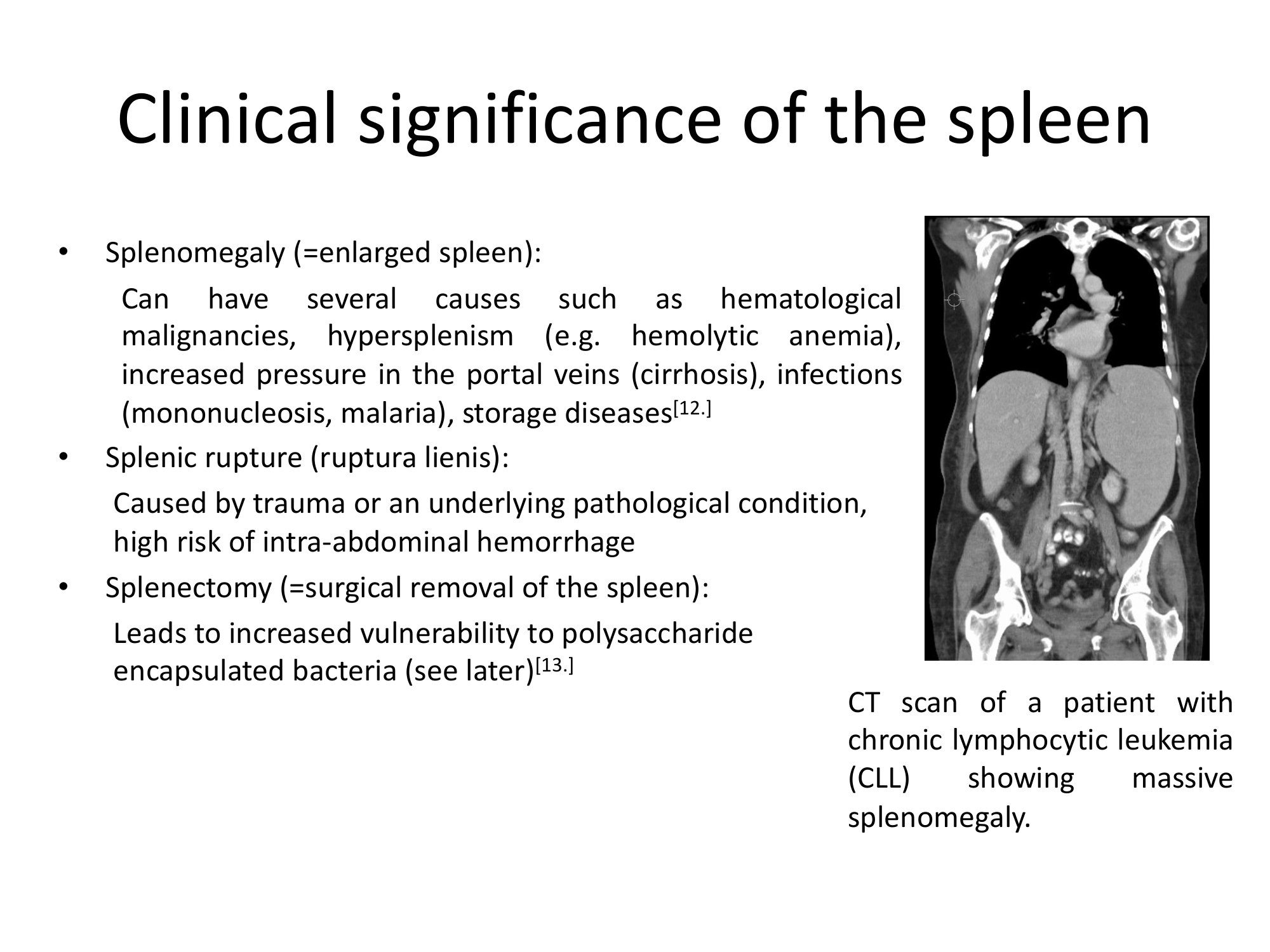 Before: Original slide 32 — splenomegaly CT scan