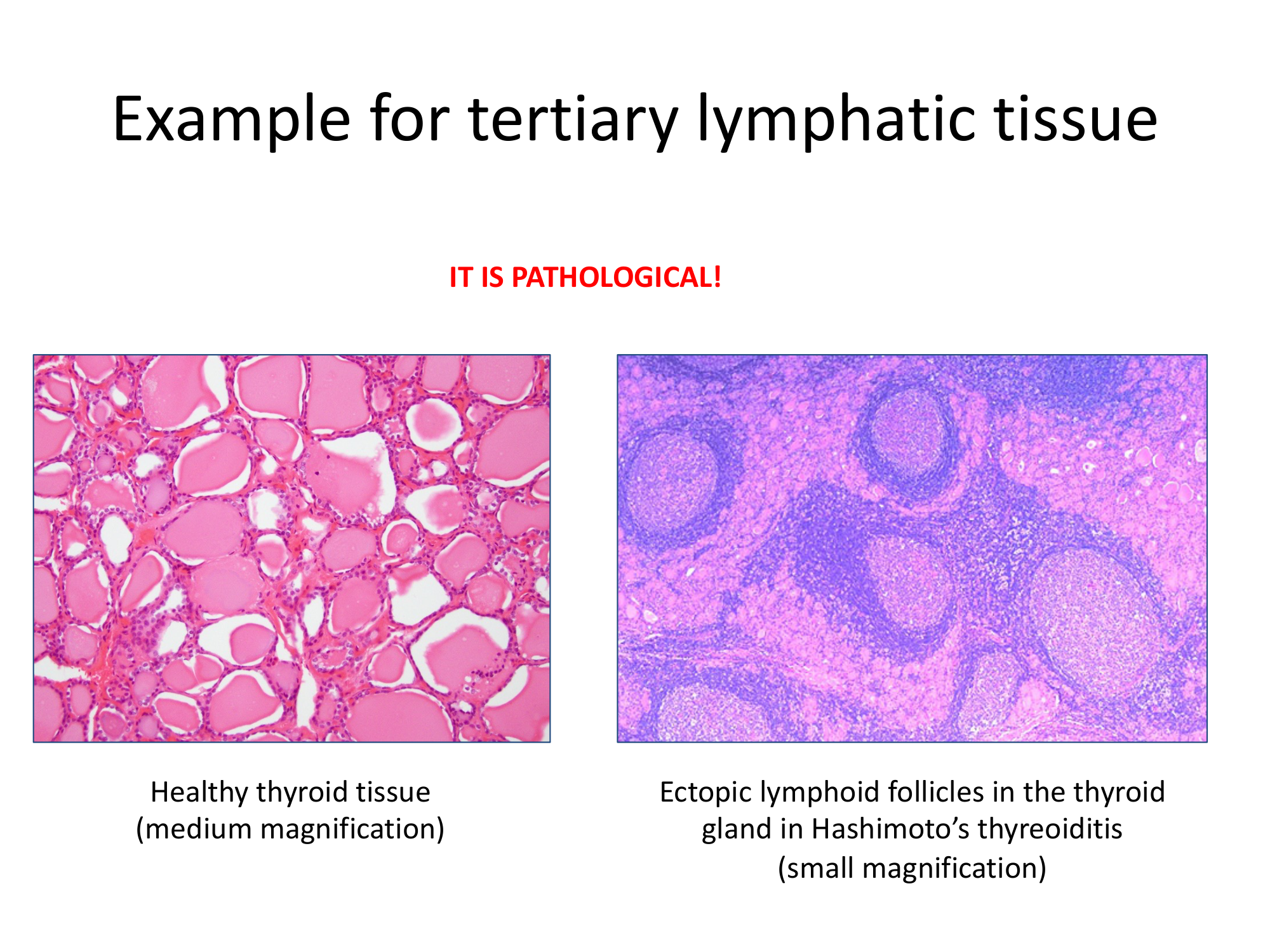 Before: Original slide 36 — thyroid tissue comparison microscopy