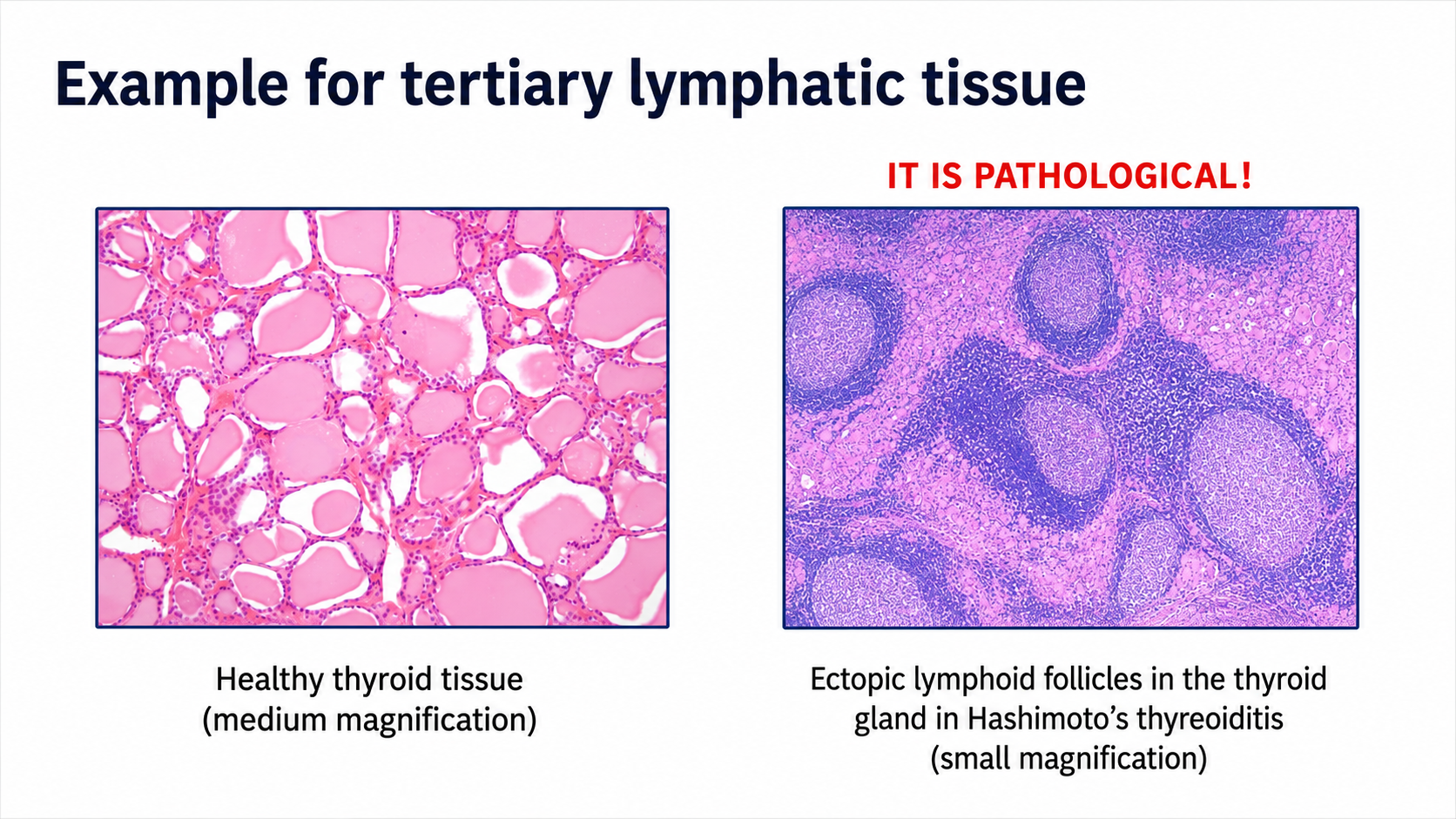 After: Redesigned slide 36 with annotated thyroid histology comparison